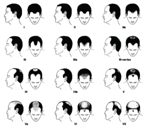 Male Pattern Baldness