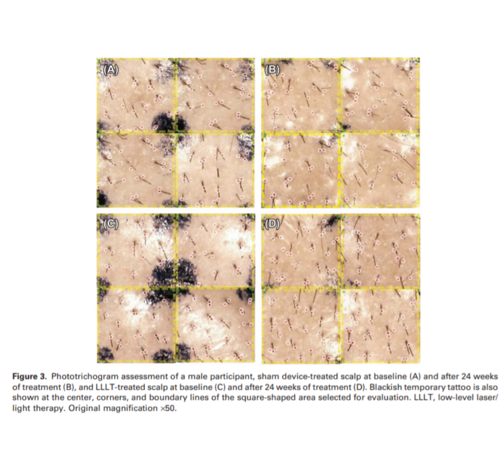 BIOLIGHT - The Efficacy and Safety of Low-Level Laser Therapy